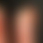 Verrucae vulgares. Exophytisch wachsendes Warzenbeet mit subungualer Infiltration an der Fingersp...