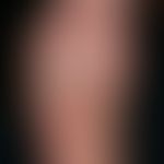 Verrucae plantares. Chronic recurrent, rough, rough, yellow-greyish, sooted papules and plaques o...