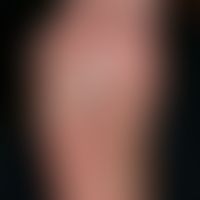 Verrucae plantares. Chronic recurrent, rough, rough, yellow-greyish, sooted papules and plaques o...