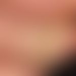 Verrucae vulgares (Detailaufnahme): flächiges Warzenbeet mit subungualer Infiltration. Aus dieser...