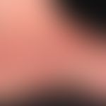 Verrucae vulgares: multiple, stellenweise beetartig aggregierte Warzenbildung. Zustand nach Chemo...