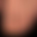 Verrucae vulgares: solitäre und&nbsp;beetartig aggregierte, Papeln und Plaques mit zerklüfteter, ...