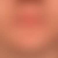 Verrucae vulgares: Multiple, sometimes pedunculated warts, infestation of the red of the lips.
