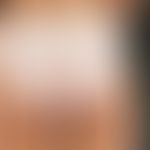Vitiligo: Large-scale depigmentation in the area of the buttocks, here as negative imprint of the...