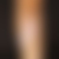 Vitiligo (segementale Vitiligo)&nbsp;Scharf begrenzte, landkartenartige, weiße Flecken im Bereich...