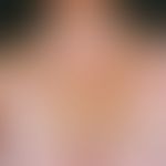 Vitiligo: extensive white areas with residual stripey pigmentation in the area of the shoulders, ...