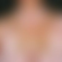 Vitiligo: extensive white areas with residual stripey pigmentation in the area of the shoulders, ...