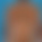 Vitiligo: First appearance 4 years ago of differently sized, differently configured, sharply defi...