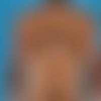 Vitiligo: First appearance 4 years ago of differently sized, differently configured, sharply defi...