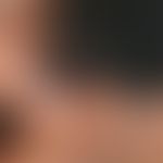Vitiligo: Sharply defined, depigmented spots on the face of a 31-year-old patient with skin type IV.