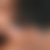 Vitiligo: Sharply defined, depigmented spots on the face of a 31-year-old patient with skin type IV.