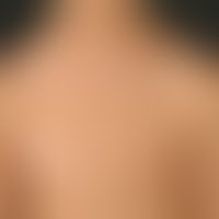Disseminated white patches up to 10 x 7.5 cm in size with involvement of the nipple on the right ...
