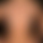 Vitiligo, general view: Multiple, since adolescence occurring, size-progressive, flat, partly biz...