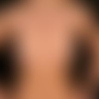 Vitiligo, general view: Multiple, since adolescence occurring, size-progressive, flat, partly biz...