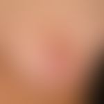 Vitiligo: (Detail enlargement): Multiple, since adolescence occurring, size-progressive, flat, pa...