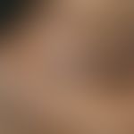 Vitiligo: Repigmentation; after intensive phototherapy brown spots appeared within the vitiligo f...
