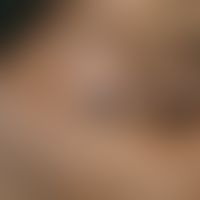 Vitiligo. Repigmentierung. Nach intensiver Phototherapie aufgetretene braune Flecken innerhalb de...