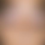 In this 12-year-old girl from India, spotty depigmentations in the area of the upper eyelids and ...