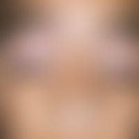 Vitiligo. Bei dem 12-jährigen Mädchen aus Indien bestehen seit einigen Jahren an Größe zunehmende...