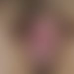 vitiligo. sharply limited, chronically stationary white spot in the area of the vulva in a 26-yea...