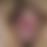 Vitiligo:&nbsp;Scharf begrenzter, chronisch stationärer, weißer Fleck im Bereich der Vulva bei ei...