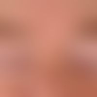 Vitiligo: alle Lider erfassende Vitiligo.
