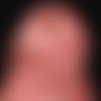 Vitiligo: flächige Depigmentierungen mit fokalen Restpigmentierungen.
