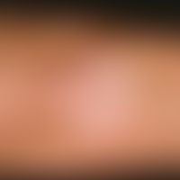Vitiligo:&nbsp;&nbsp;isolierter scharf berandeter weißer Fleck.&nbsp;
