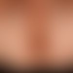Vitiligo: large symmetrical area of the genito-anal and buttock region, central strip in the geni...
