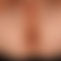 Vitiligo: großflächige symmetrische der Genito-Anal - und Gesäßregion. Zentraler Streifen im Geni...