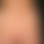 Vitiligo : On the right side of the picture a halo-nevus; in the larger vitiligo focus above the ...