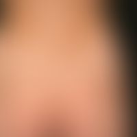 Vitiligo : On the right side of the picture a halo-nevus; in the larger vitiligo focus above the ...