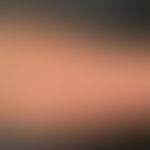 Lupus erythematodes tumidus. Dezent infiltrierte, livide, nummuläre Erytheme mit fehlender epider...