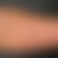 Lupus erythematodes tumidus. Dezent infiltrierte, livide, nummuläre Erytheme mit fehlender epider...