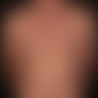 Lupus erythematodes tumidus.&nbsp;Chronisch stationärer Verlauf der Hauterscheinungen. Keine wese...
