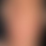 Lupus erythematodes tumidus: seit mehreren Jahren chronisch rezidivierendes Krankheitbild. Wenig ...
