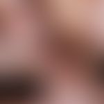 Wegener's granulomatosis, extensive ulcerations with smeary-encrusted deposits in the area of the...