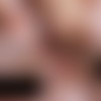 Granulomatose mit Polyangiitis&nbsp;(Wegener-Granulomatose):&nbsp;Flächige Ulzerationen mit schmi...