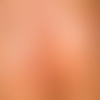Pseudomonas folliculitis, detail enlargement: follicularly bound erythematous papules, partly gla...
