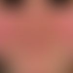 Lupus erythematosus systemic. persistent, blurred, deep red, butterfly-like erythema in the face ...