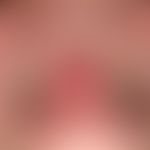 Lupus erythematosus, systemic. 29-year-old female patient with persistent, clearly progressive, p...