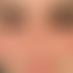 Lupus erythematosus systemic: persistent, blurred, red, butterfly-like distributed spots in the r...