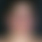 lupus erythematosus systemic. persistent, sharply defined, symmetrical, non-scaly erythema of the...