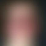 Systemic lupus erythematosus: multiple, chronic persistent, blurred, symmetrical, slightly burnin...