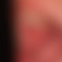 Systemic lupus erythematosus: changes in the oral mucosa with extensive erosions and veil-like wh...