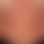 Systemic lupus erythematosus:chronic, locally constant exanthema consisting of spots, papules and...