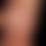 Systemic lupus erythematosus:chronic, UV-provocable, maculo-papular exanthema; concomitant: recur...