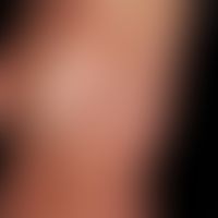 Systemic lupus erythematosus:chronic, UV-provocable, maculo-papular exanthema; concomitant: recur...