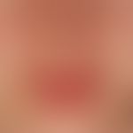 Systemic lupus erythematosus: persistent, light-provocable, deep red plaques in the face of a 22-...