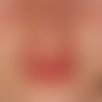 Lupus erythematodes systemischer: persistierende, licht-provozierbare sattrote, Plaques im Gesich...